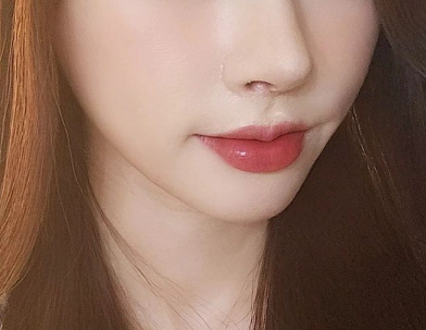 hàm thon gọn sau khi tiêm botox.