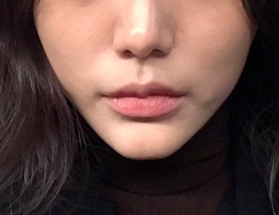 botox giúp giảm nhăn rãnh cười.