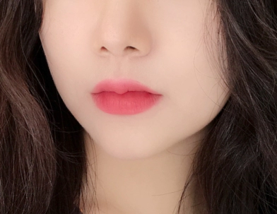 rãnh cười không còn nhăn sau khi tiêm botox.