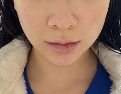 Khuôn mặt mất thể tích trước khi tiêm filler.