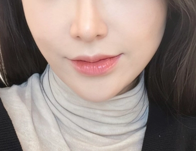 Phụ nữ được tiêm filler tạo hình ở nhiều vùng trên mặt.