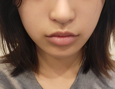 Phụ nữ mất thể tích khuôn mặt trước khi tiêm filler.