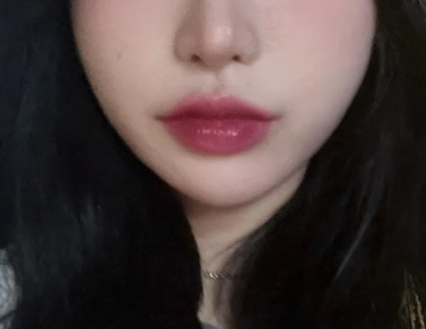 Phụ nữ sau khi tiêm filler tạo hình để cải thiện thể tích.