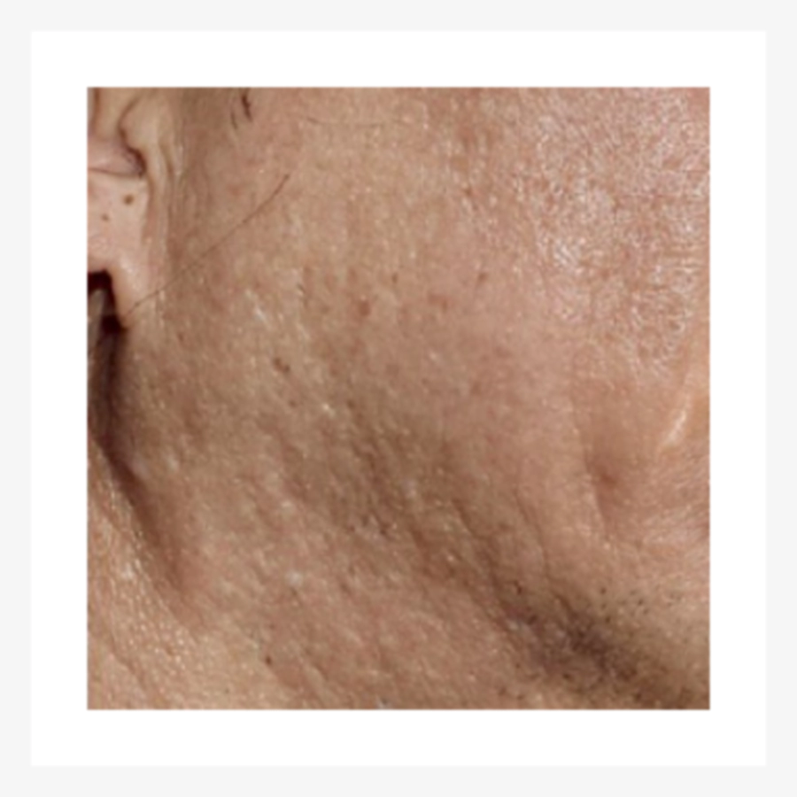 Làn da kém đàn hồi và nhiều nếp nhăn nhỏ, đối tượng của skin booster Juvelook.