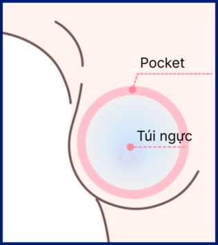 Pocket MINE tạo ra có kích cỡ phù hợp với túi ngực khi nâng ngực.