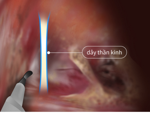 nâng ngực và bảo tồn được những dây thần kinh bên trong.