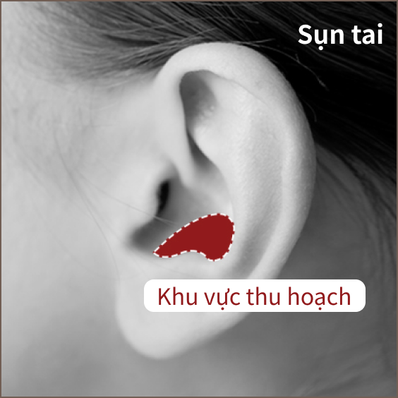 Phần sụn tai được sử dụng khi nâng mũi.