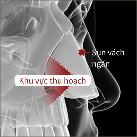 Sụn vách ngăn mũi được dùng khi nâng mũi.