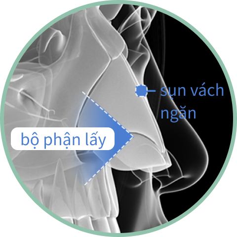 Phần sụn vách ngăn được sử dụng khi nâng mũi.