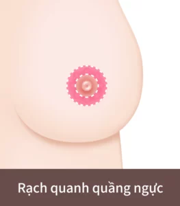 phẫu thuật ngực xệ thông qua đường rạch quanh quầng ngực.