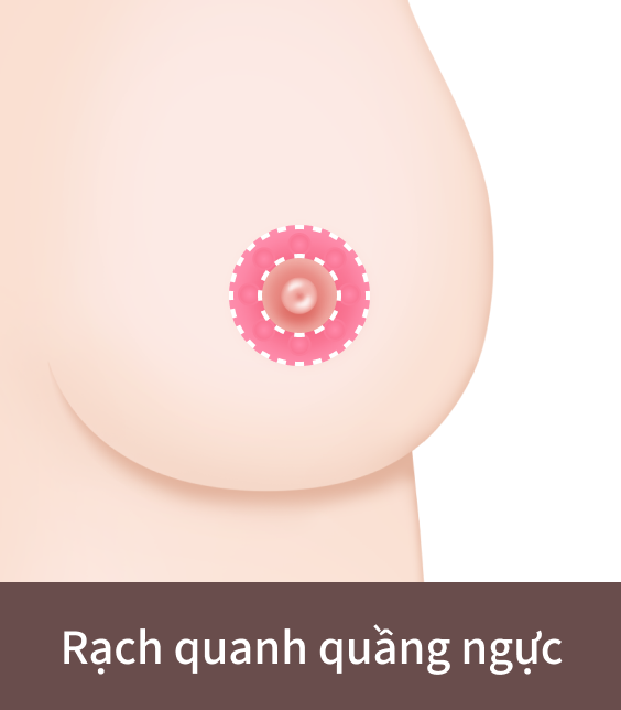 phẫu thuật ngực xệ thông qua đường rạch quanh quầng ngực.