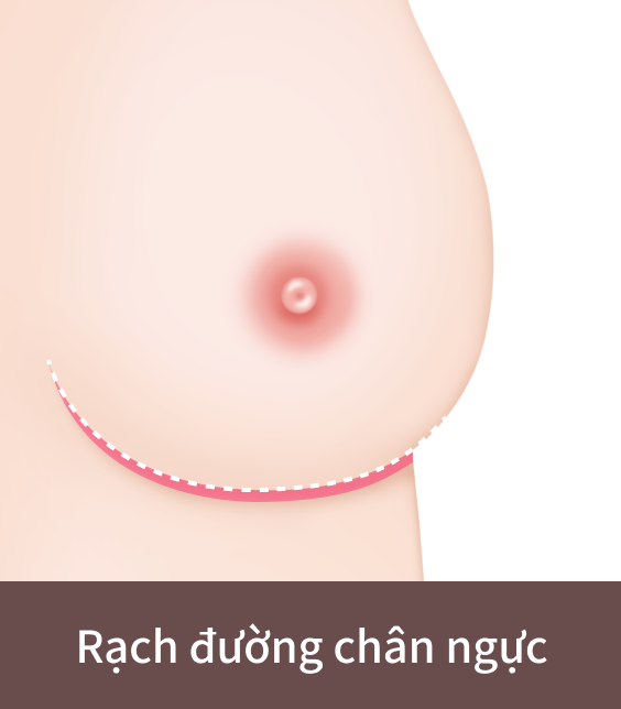 phẫu thuật cải thiện ngực xệ bằng đường rạch ở đường chân ngực.