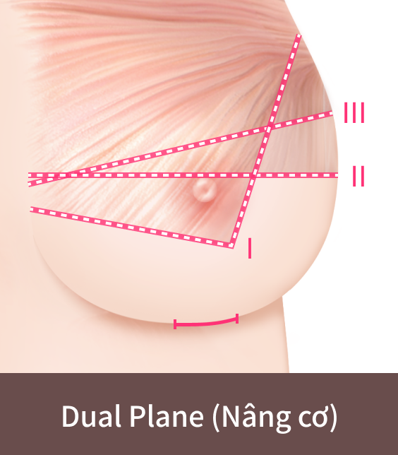 phẫu thuật ngực xệ theo phương pháp dual plane.