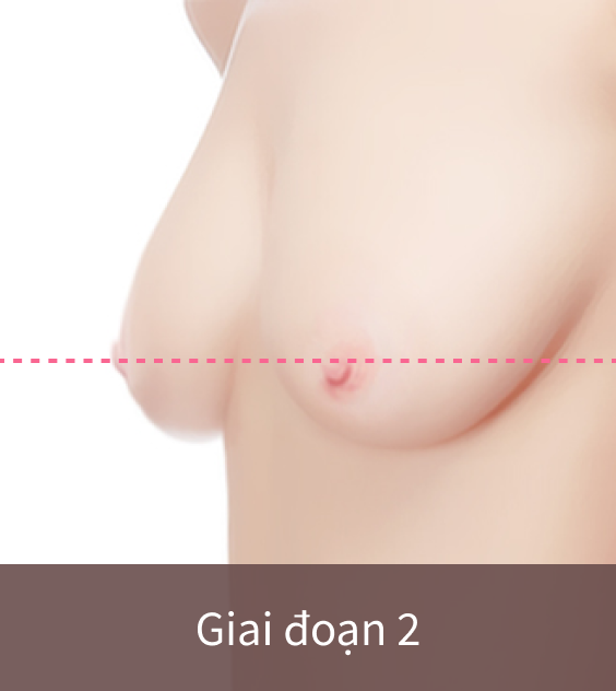 ngực xệ thuộc giai đoạn 2.