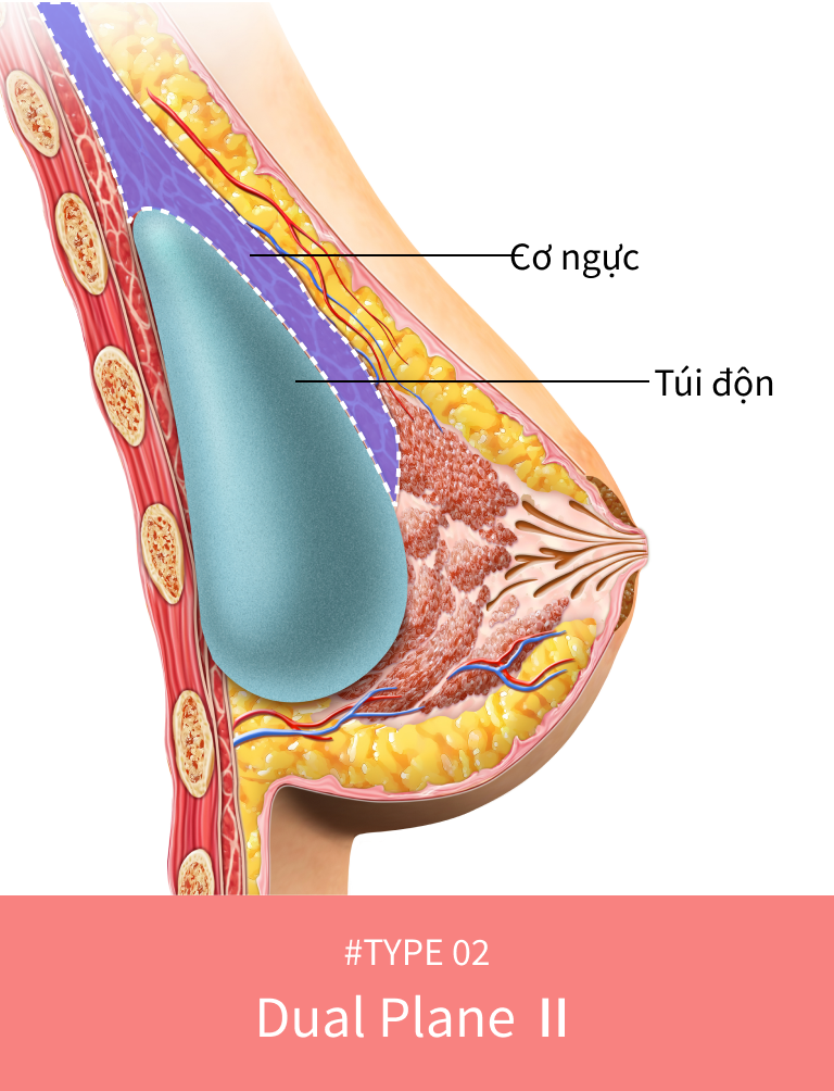 Túi ngực được đặt dưới cơ ngực khi phẫu thuật ngực xệ.