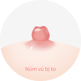 hình ảnh núm vú bị to và cần phải thu nhỏ đầu ti.