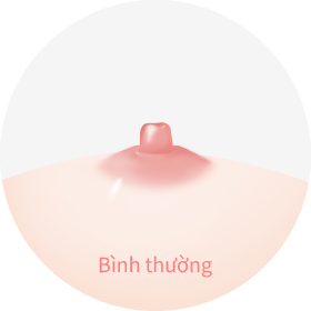 hình ảnh núm vú có kích thước bình thường.