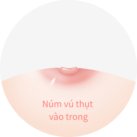 hình ảnh núm vú bị thụt vào trong.