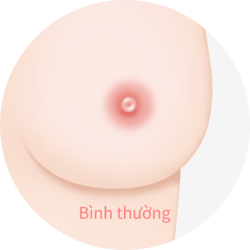 quầng ngực có kích cỡ bình thường.
