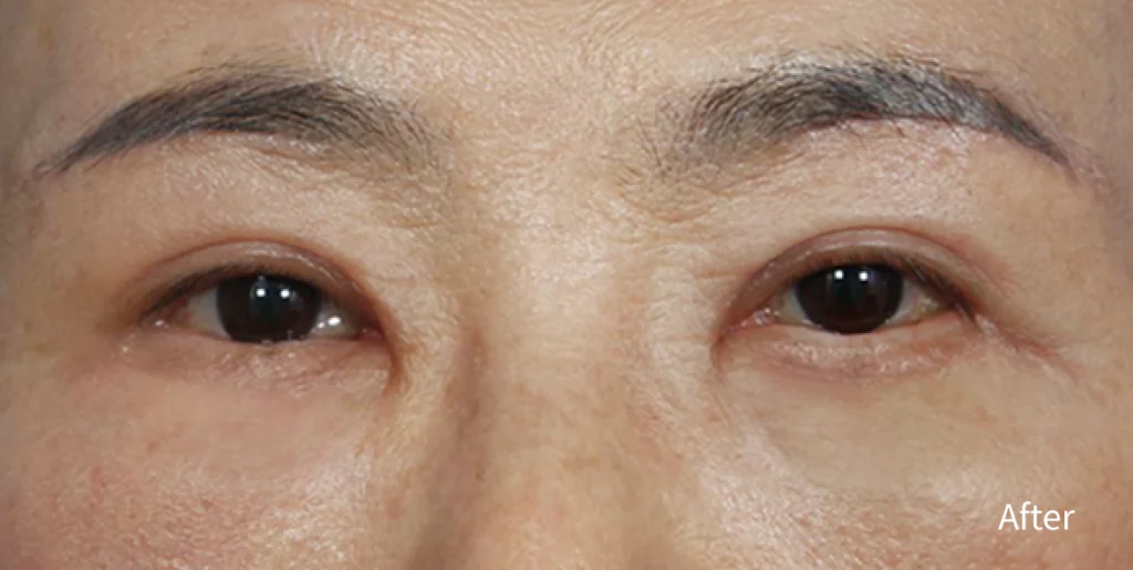 sau khi phẫu thuật mắt.