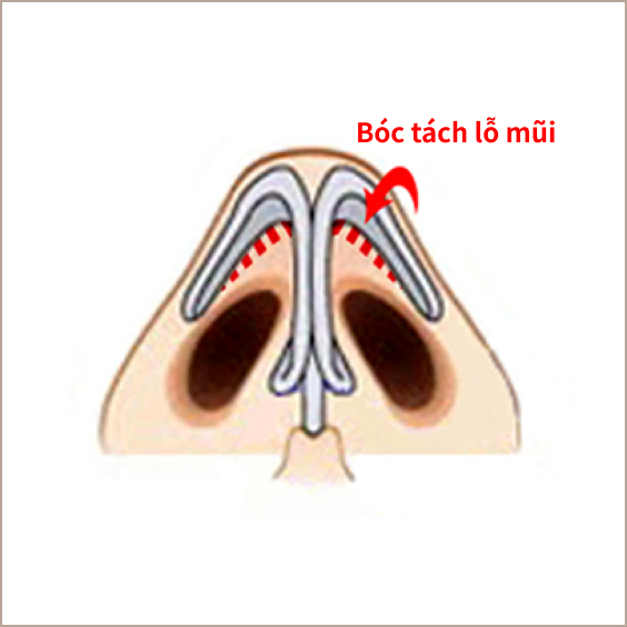 Cách bóc tách lỗ mũi khi nâng mũi.