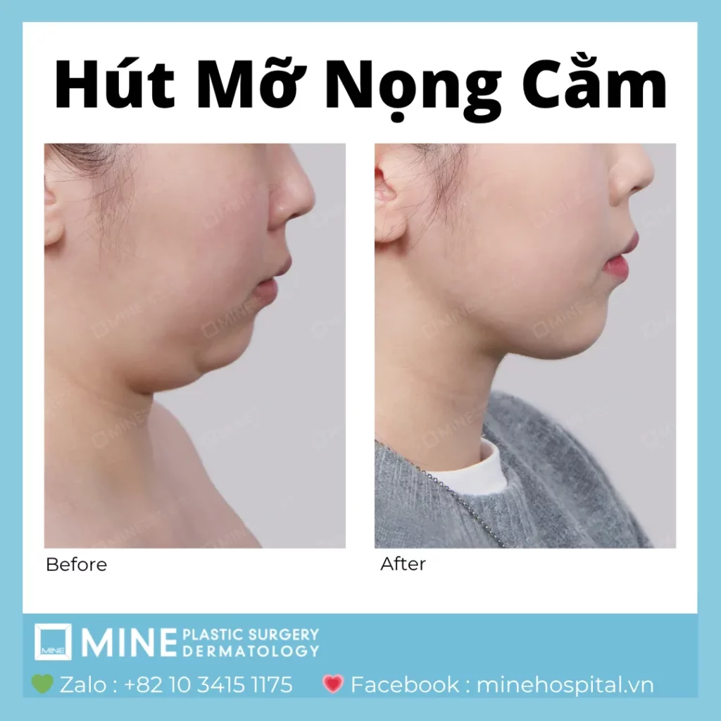 GIẢM NỌNG CẰM CẤP TỐC TRONG THỜI GIAN NGẮN