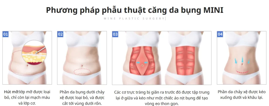 BÁC SĨ TƯ VẤN CHI PHÍ CẮT MỠ BỤNG TẠI HÀ NỘI UY TÍN
