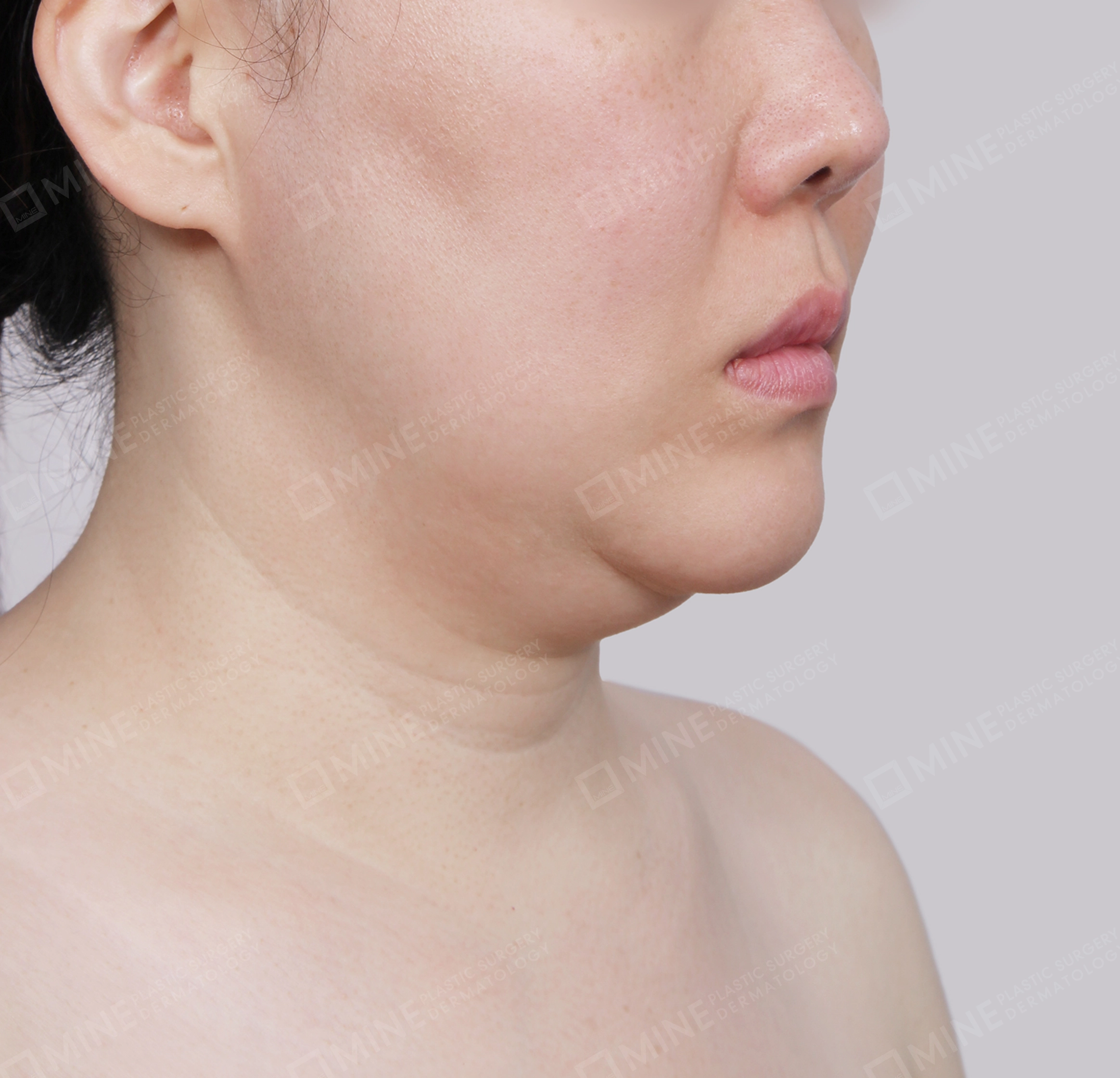 Căng da cổ Mini-Mặt trước-Trước