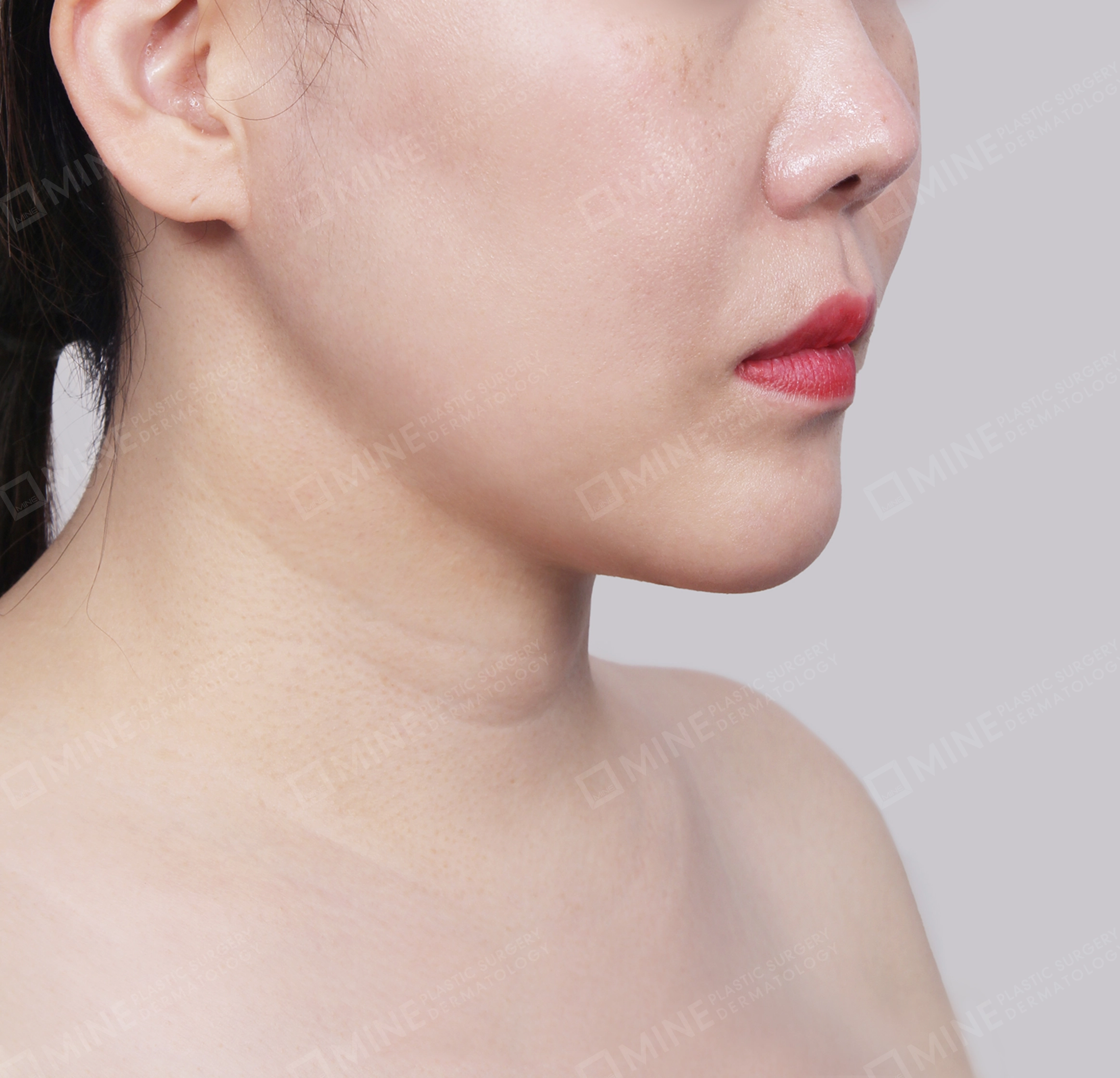 Căng da cổ Mini-Mặt trước-Sau