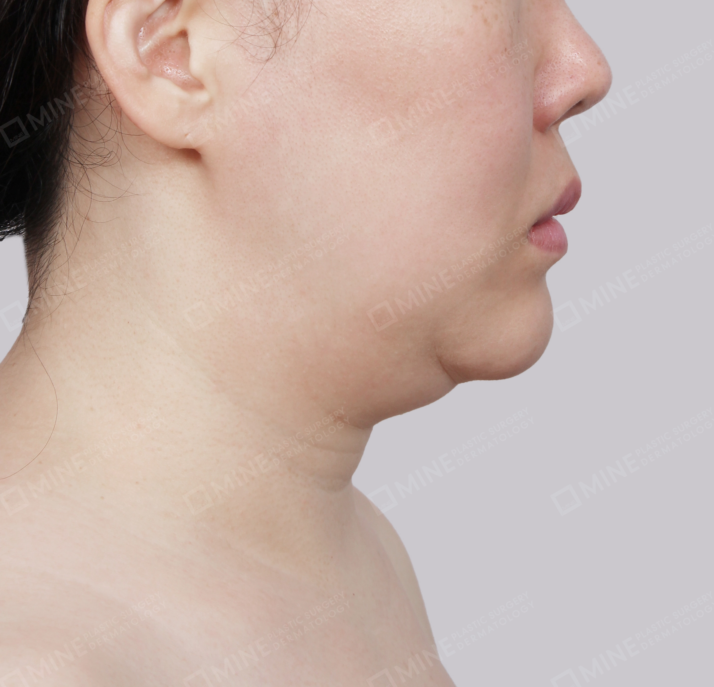 Căng da cổ Mini-Mặt bên-Trước