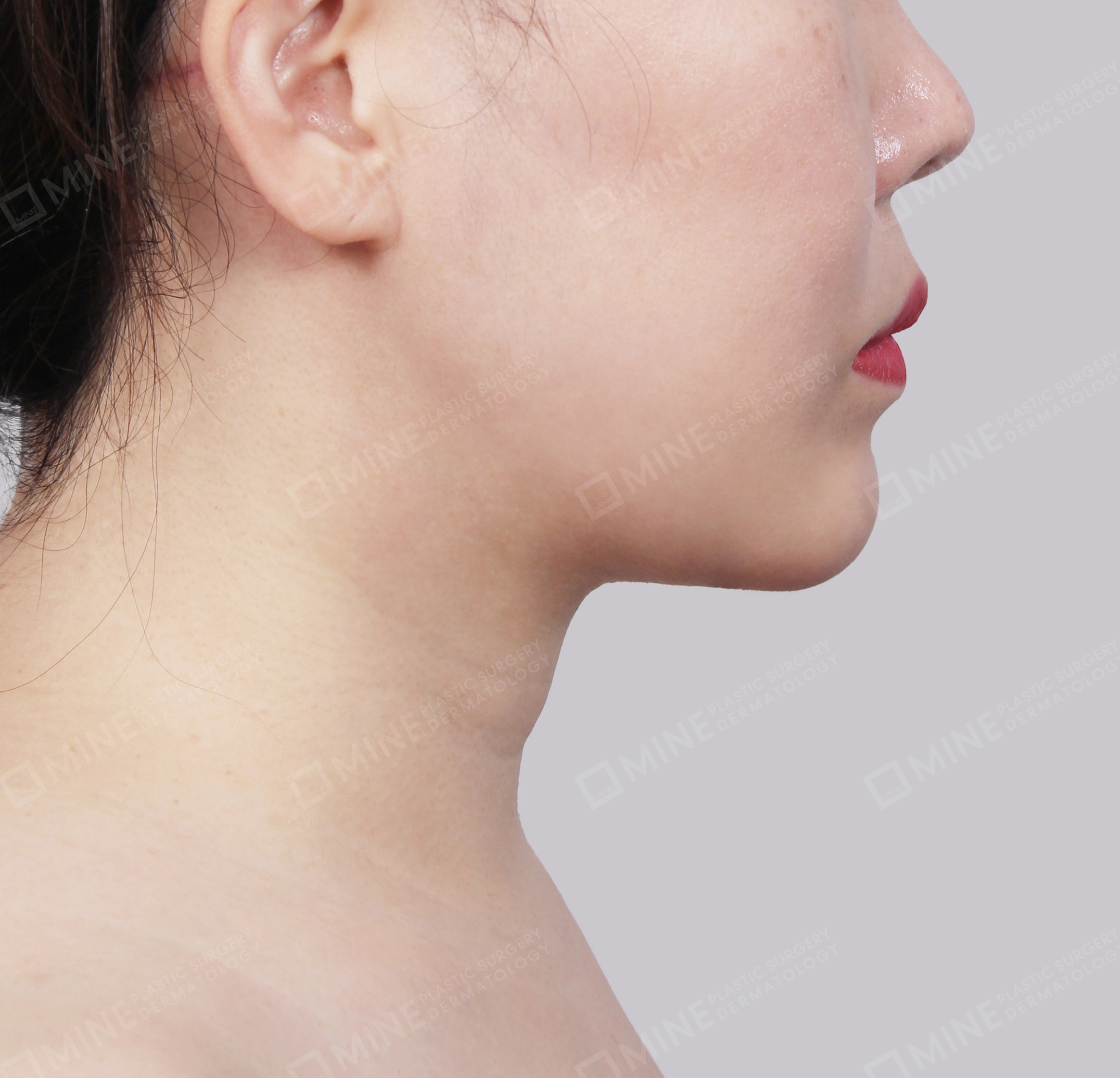 Căng da cổ Mini-Mặt bên-Sau