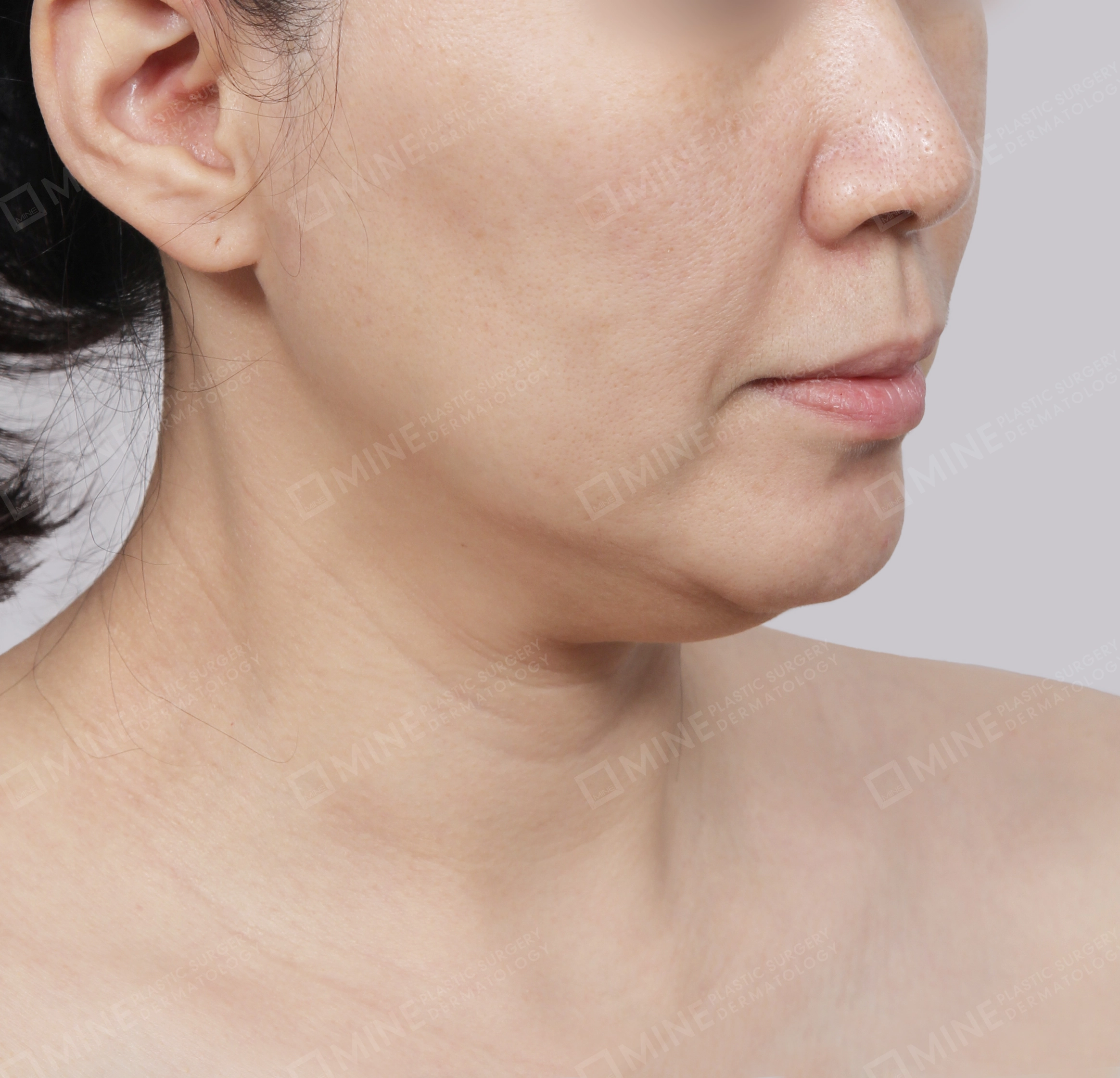 Căng da cổ Mini-Mặt trước-Trước
