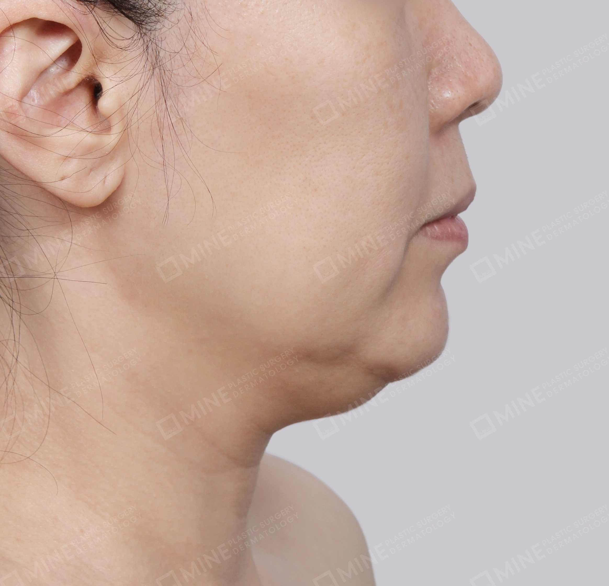 Căng da cổ Mini-Mặt bên-Trước