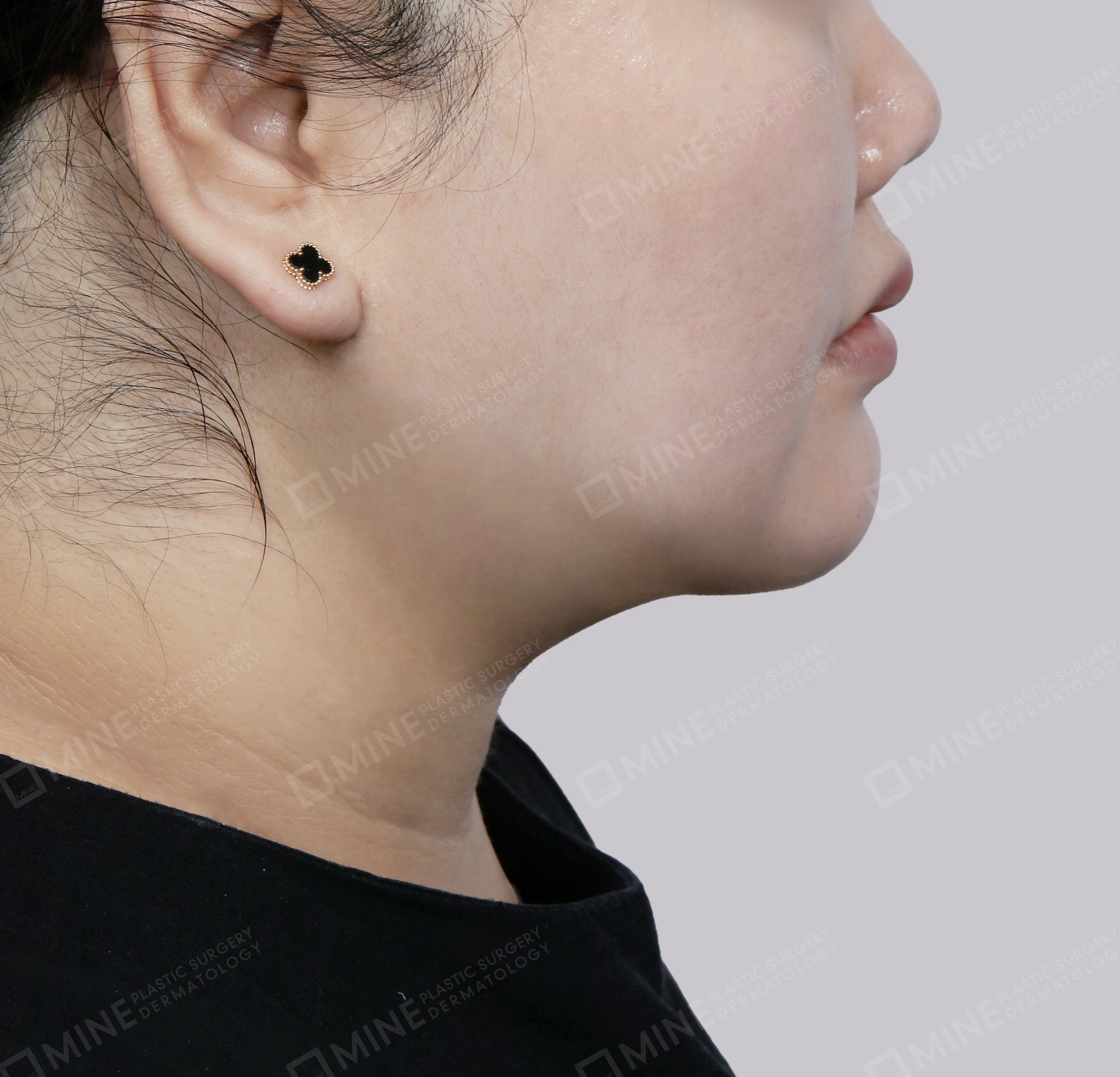 Căng da cổ Mini-Mặt bên-Sau