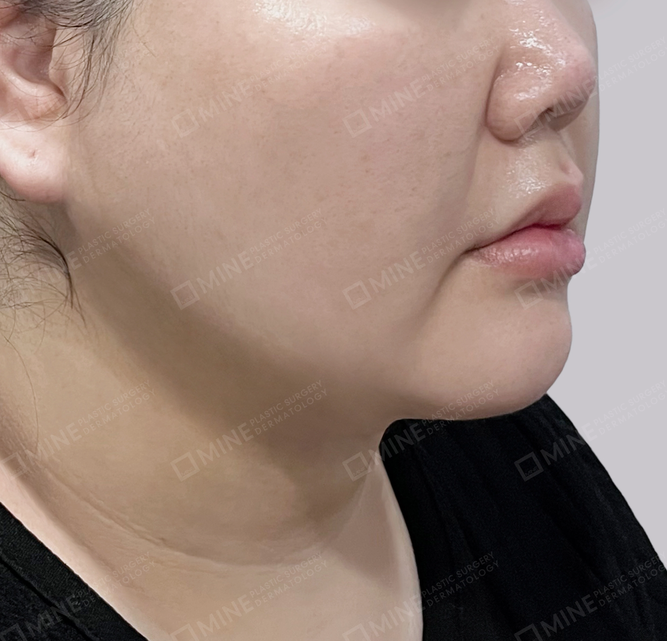 Căng da cổ Mini-45 độ-Sau