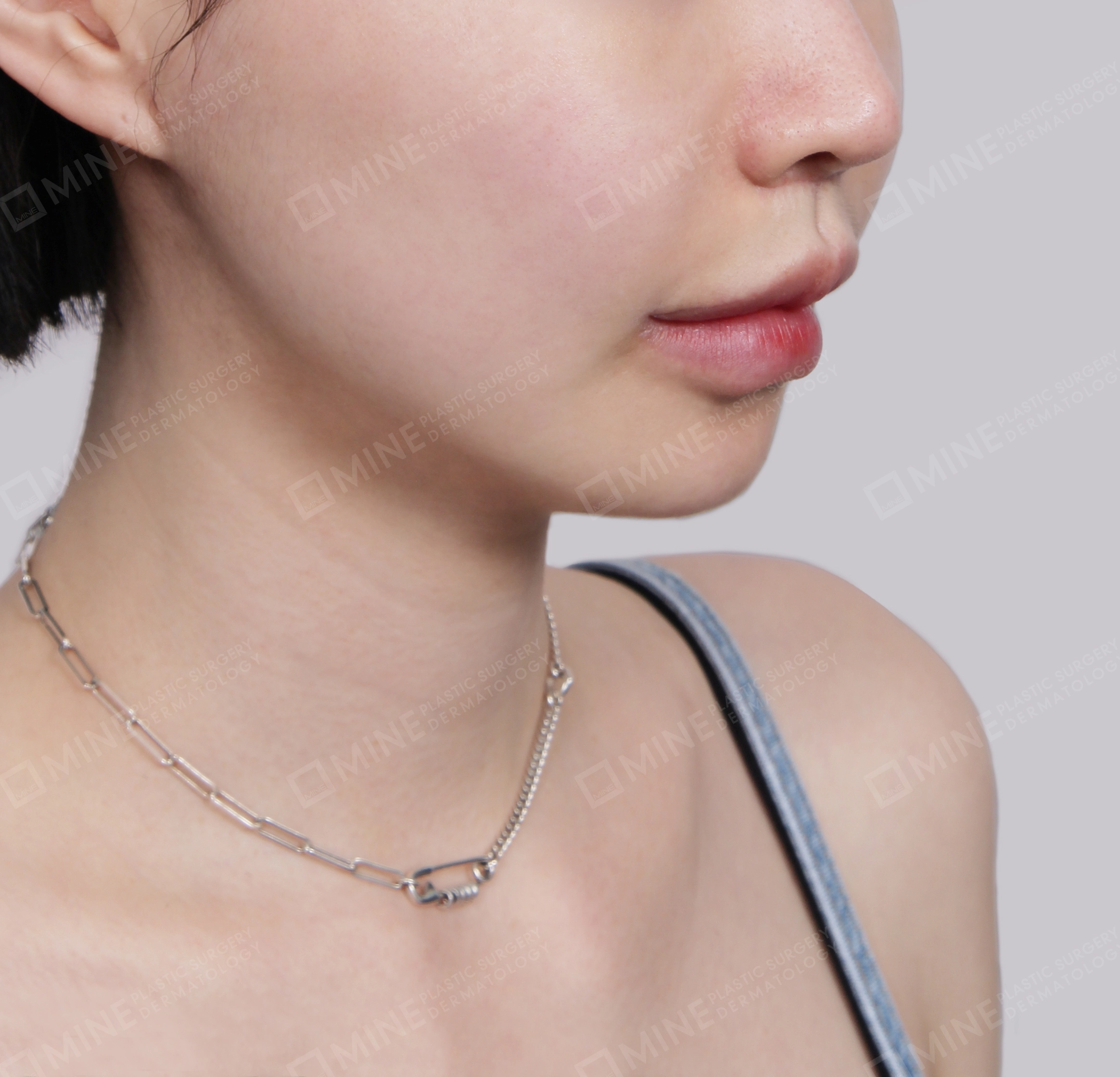 Căng da cổ Mini-Mặt trước-Sau