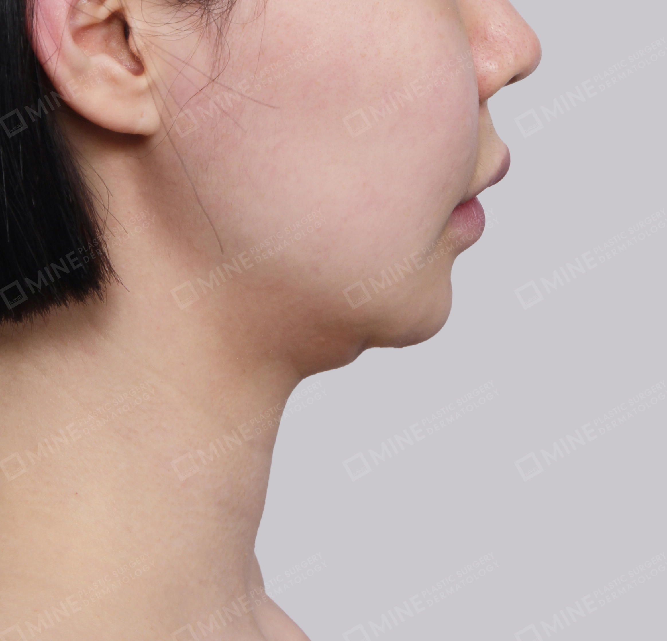 Căng da cổ Mini-Mặt bên-Trước