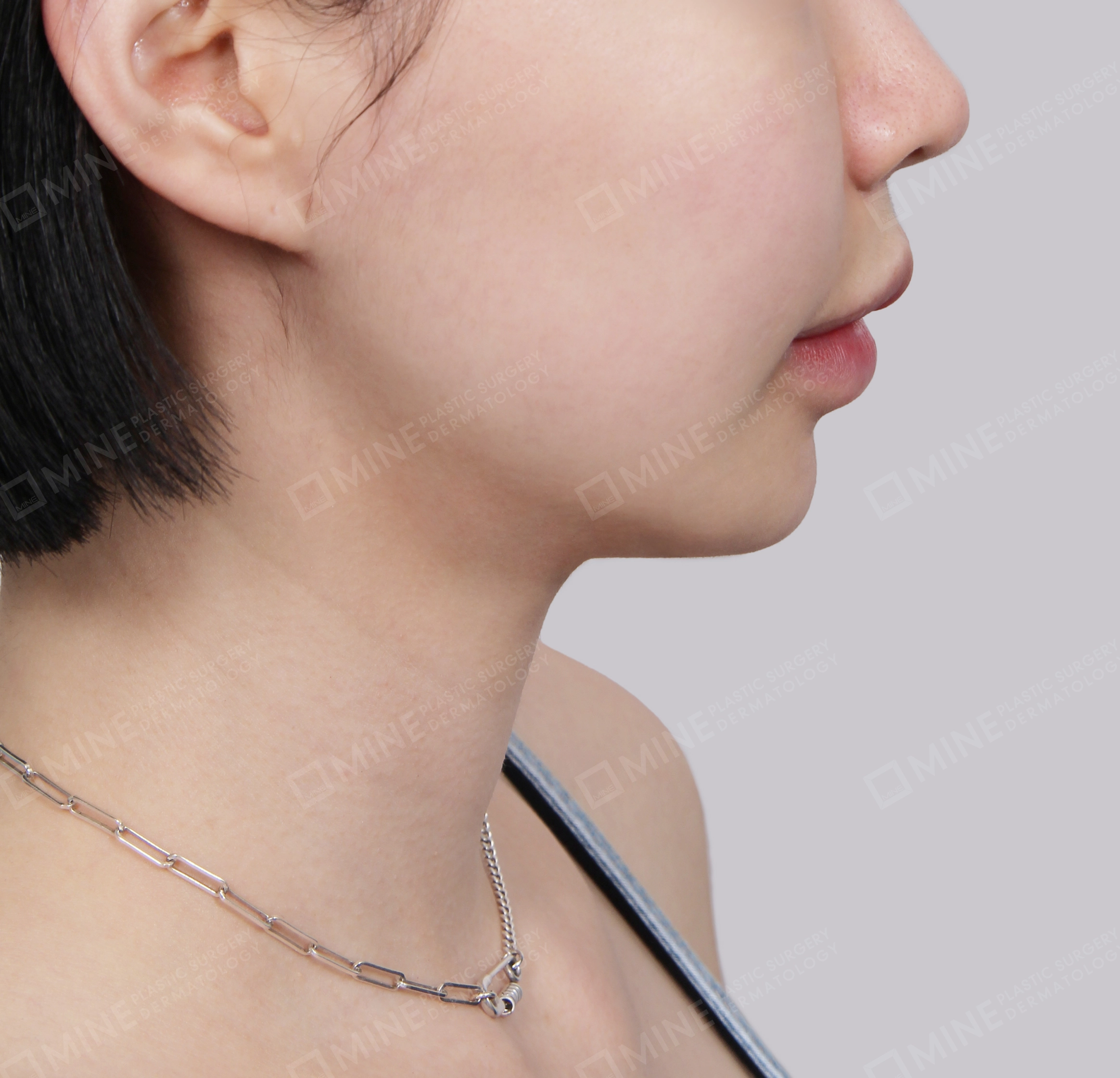 Căng da cổ Mini-Mặt bên-Sau