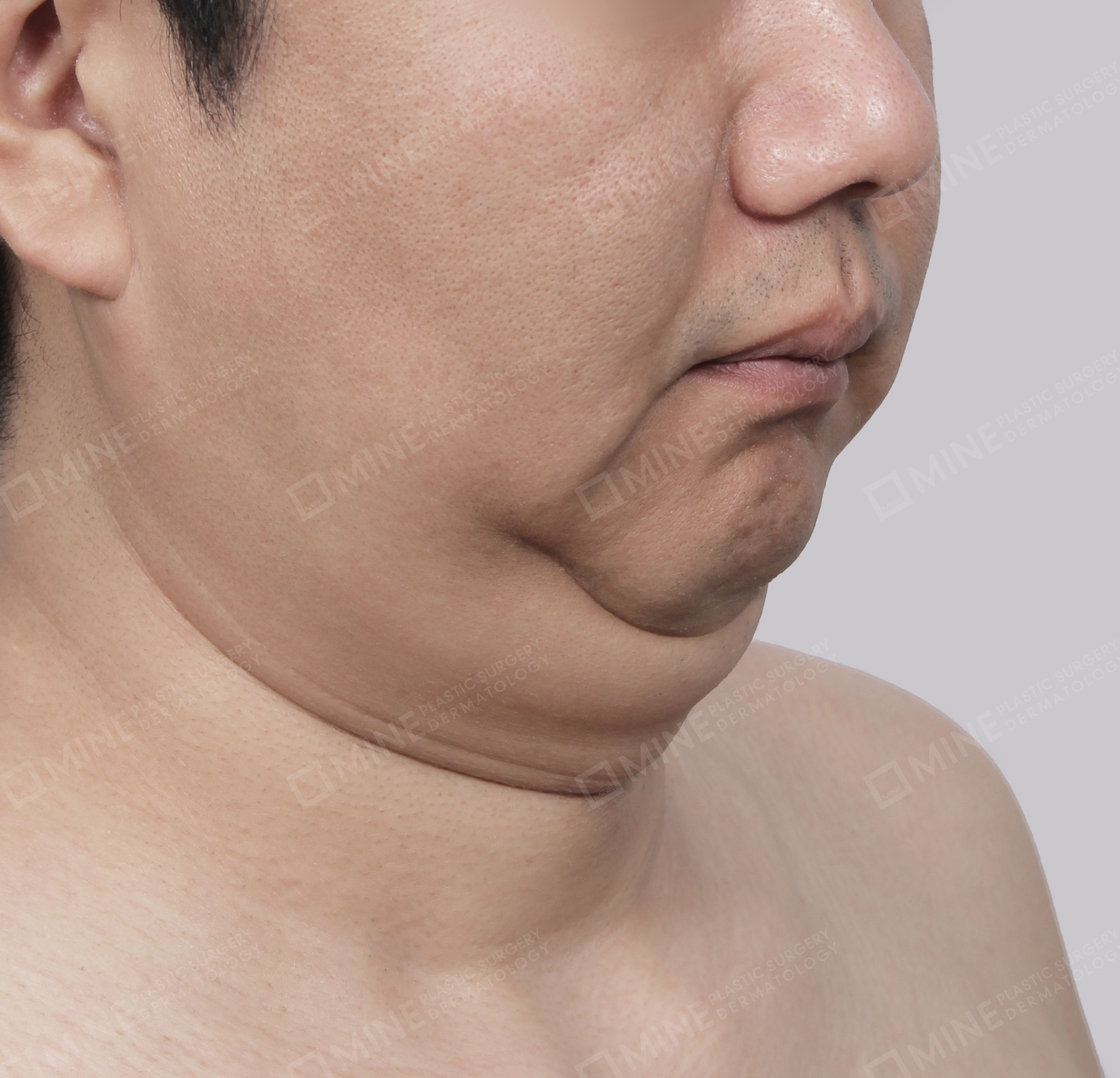Căng da cổ Mini-Mặt trước-Trước