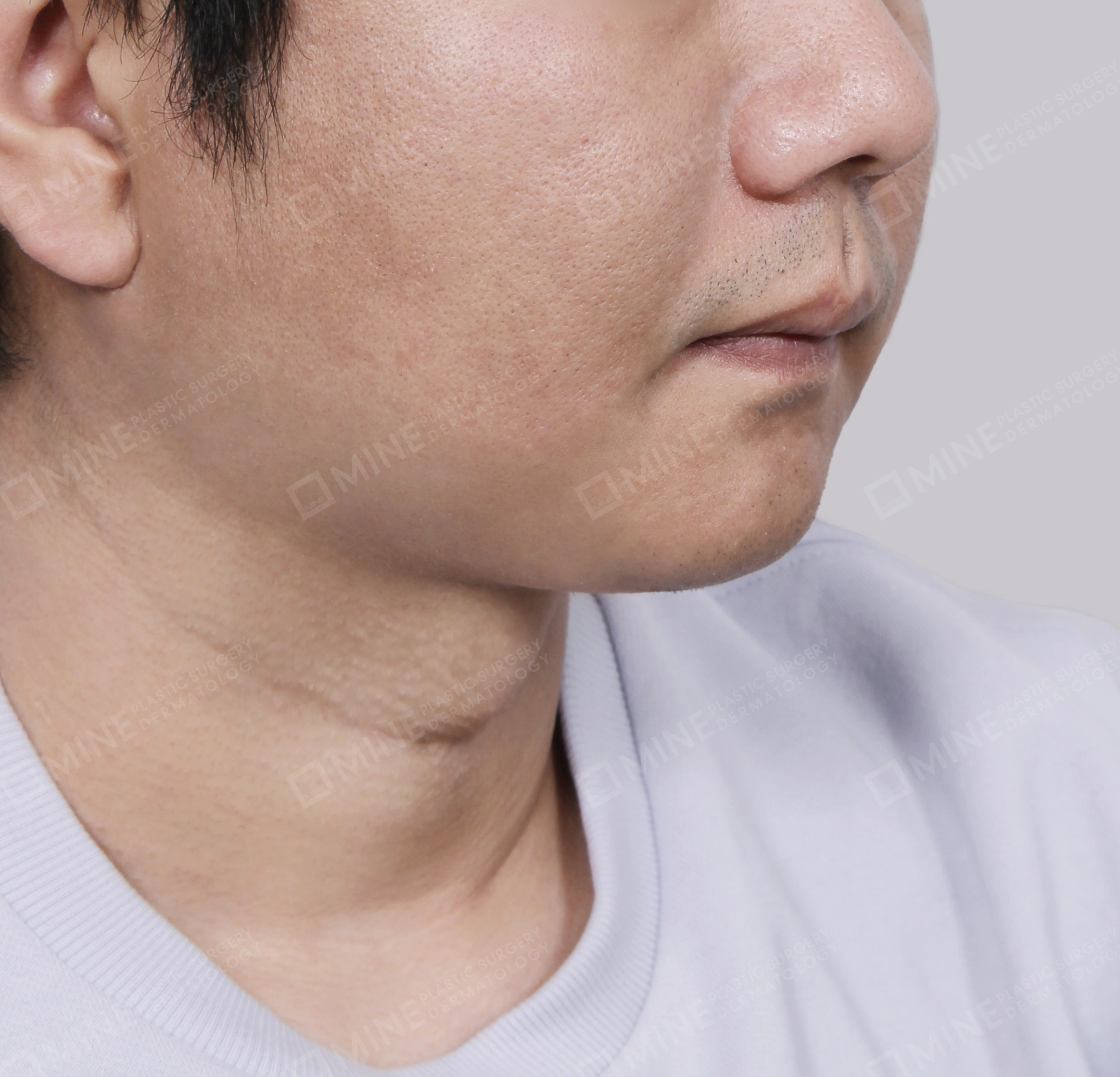 Căng da cổ Mini-Mặt trước-Sau