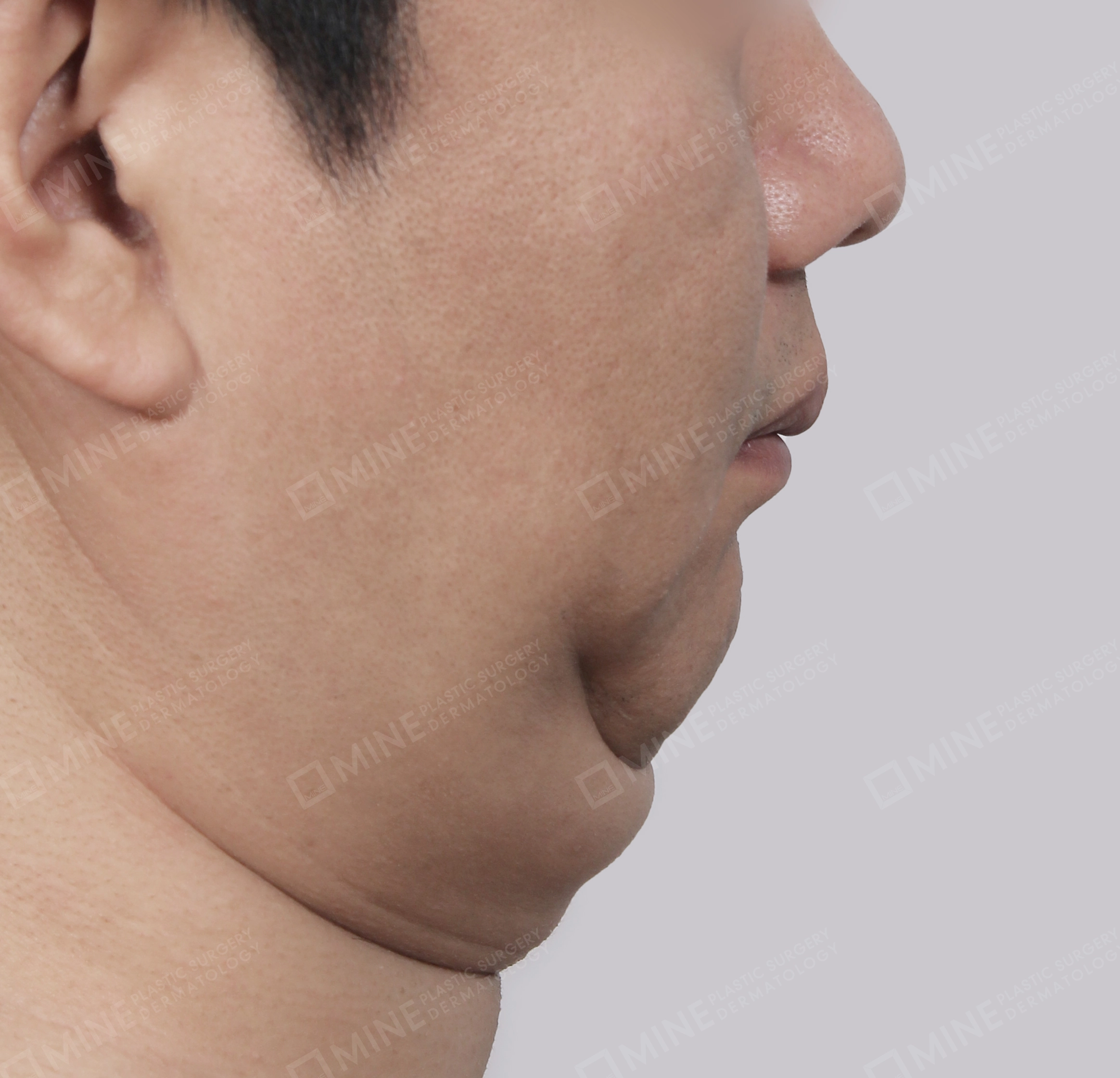 Căng da cổ Mini-Mặt bên-Trước