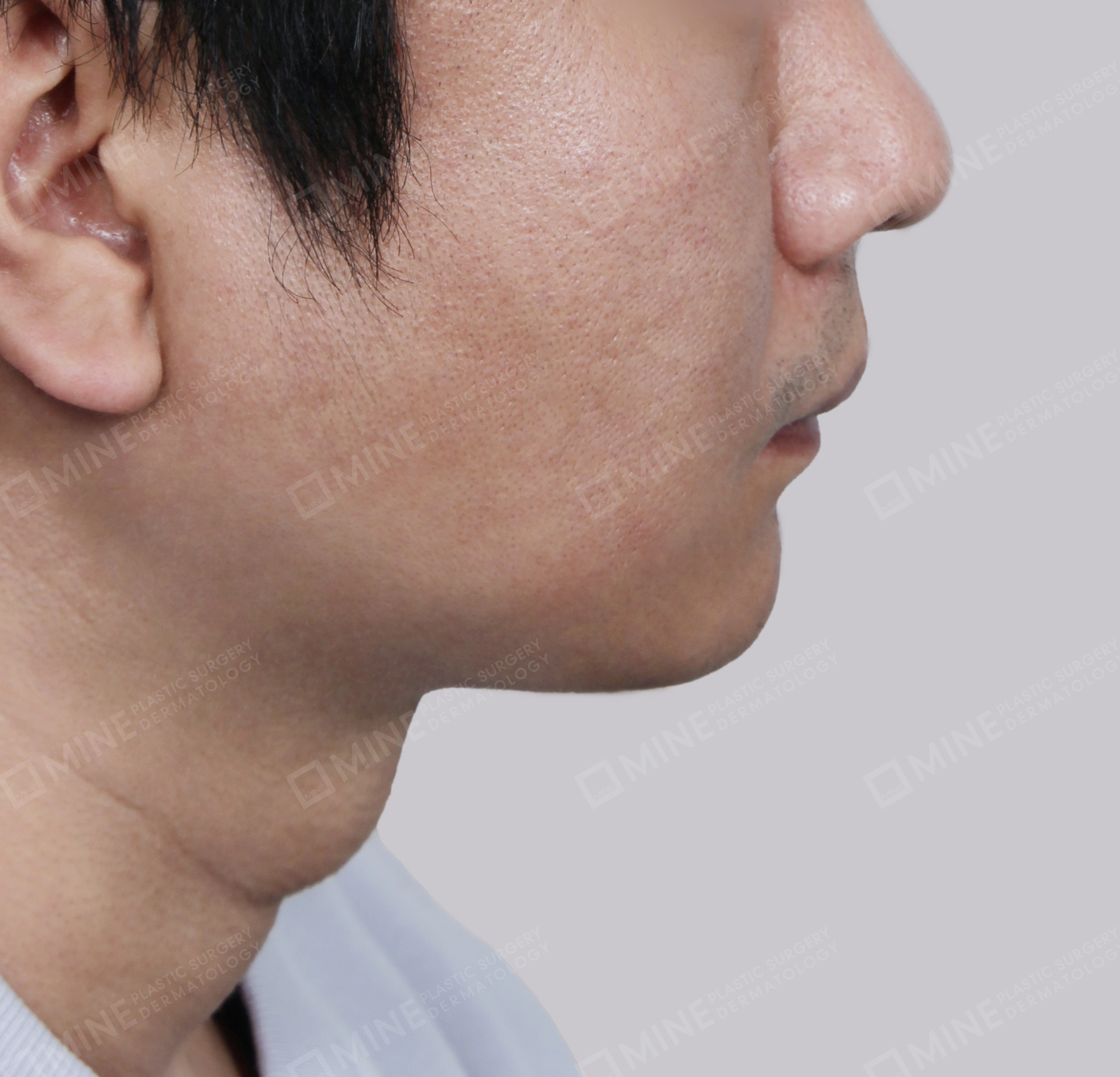 Căng da cổ Mini-Mặt bên-Sau