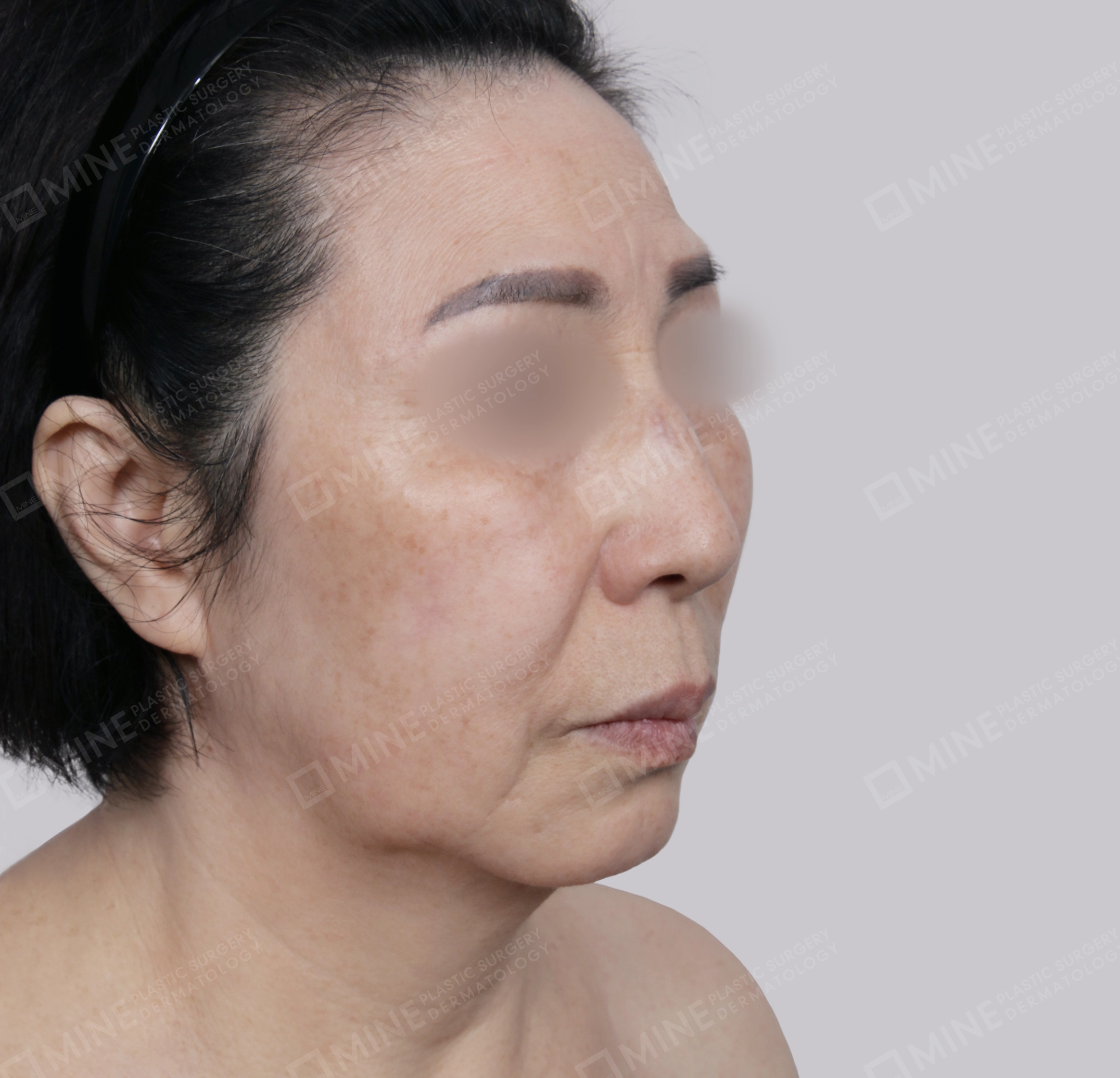 Căng da toàn mặt-Mặt trước-Trước