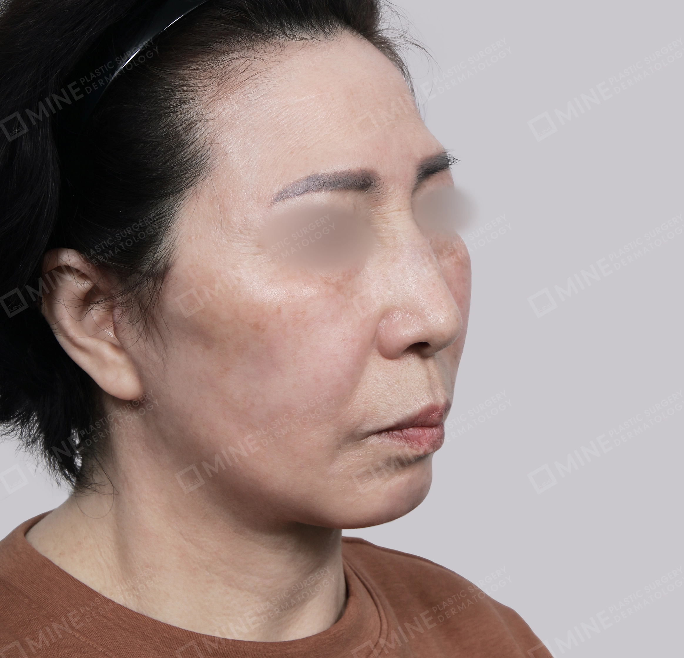 Căng da toàn mặt-Mặt trước-Sau