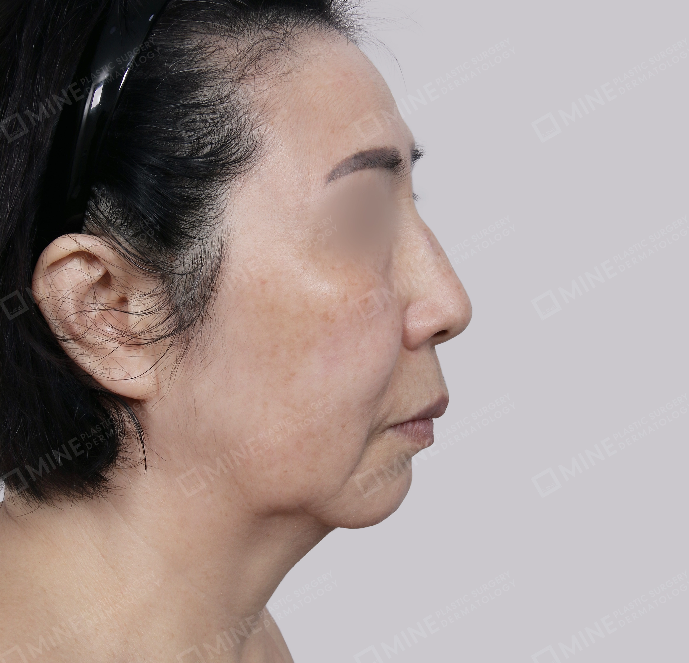 Căng da toàn mặt-Mặt bên-Trước