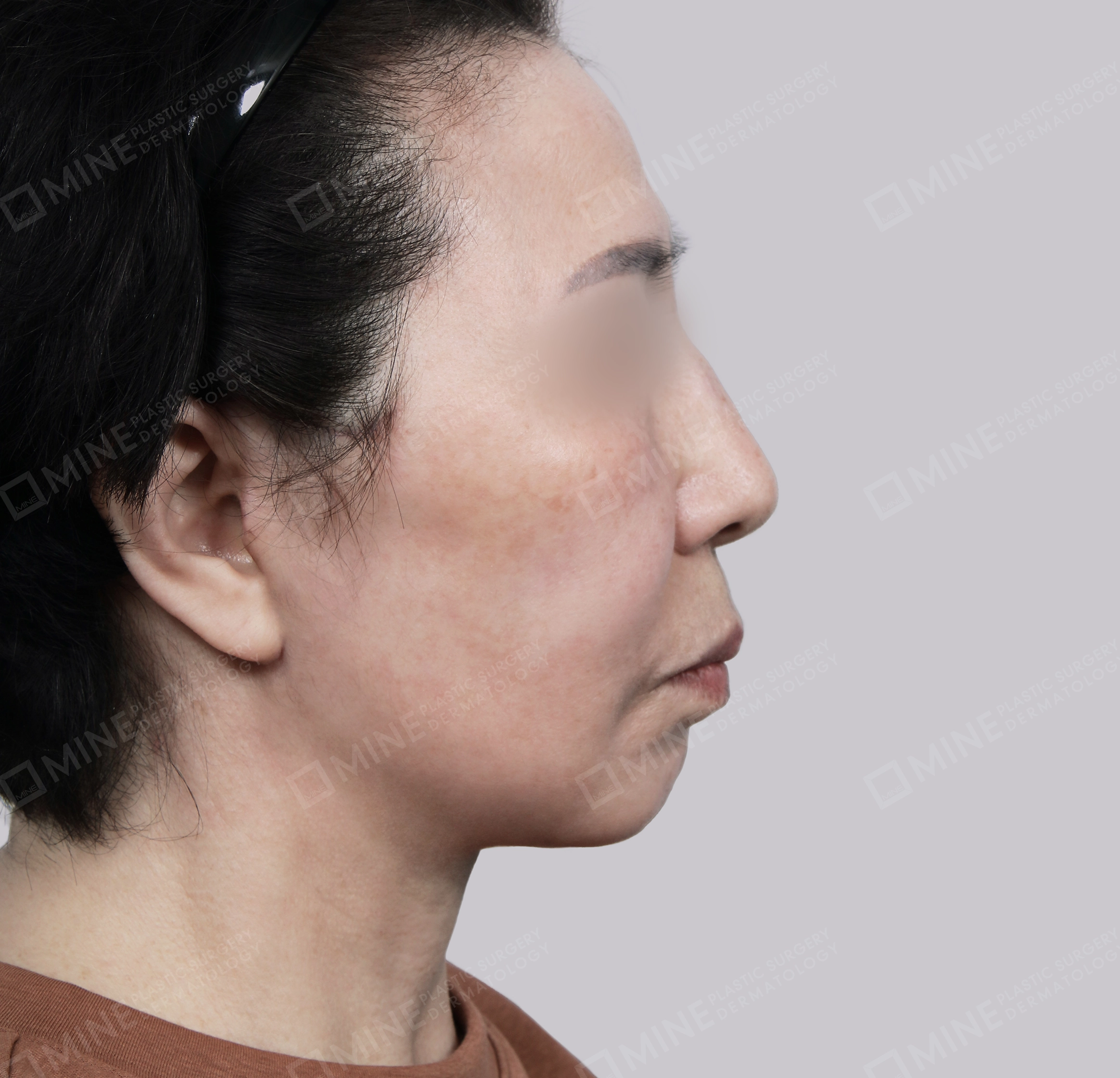 Căng da toàn mặt-Mặt bên-Sau