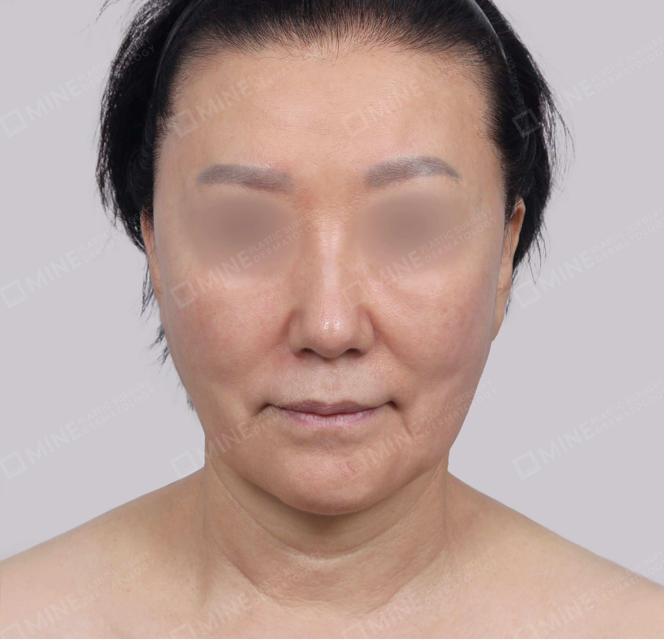 Căng da toàn mặt-Mặt trước-Trước