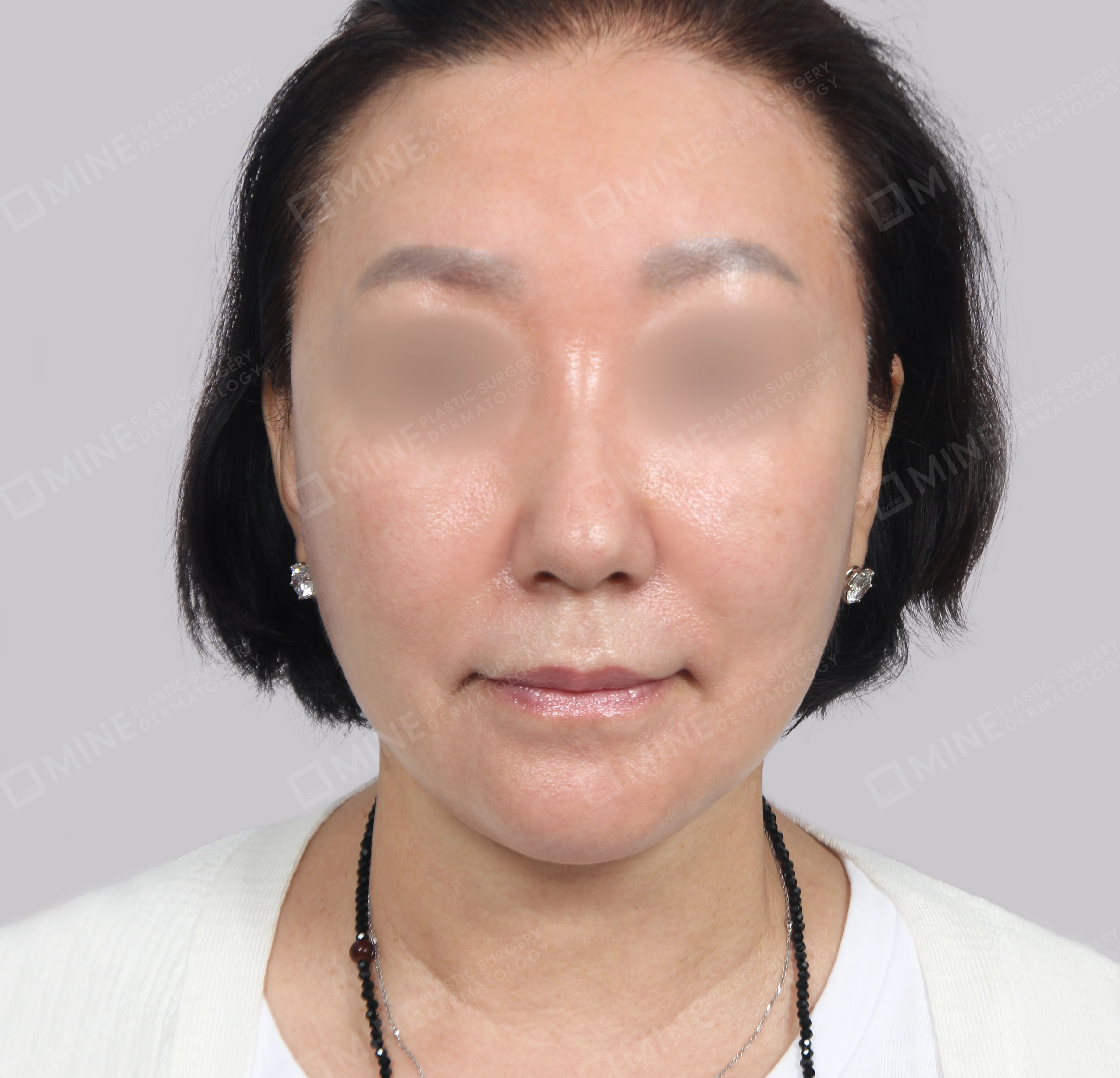 Căng da toàn mặt-Mặt trước-Sau