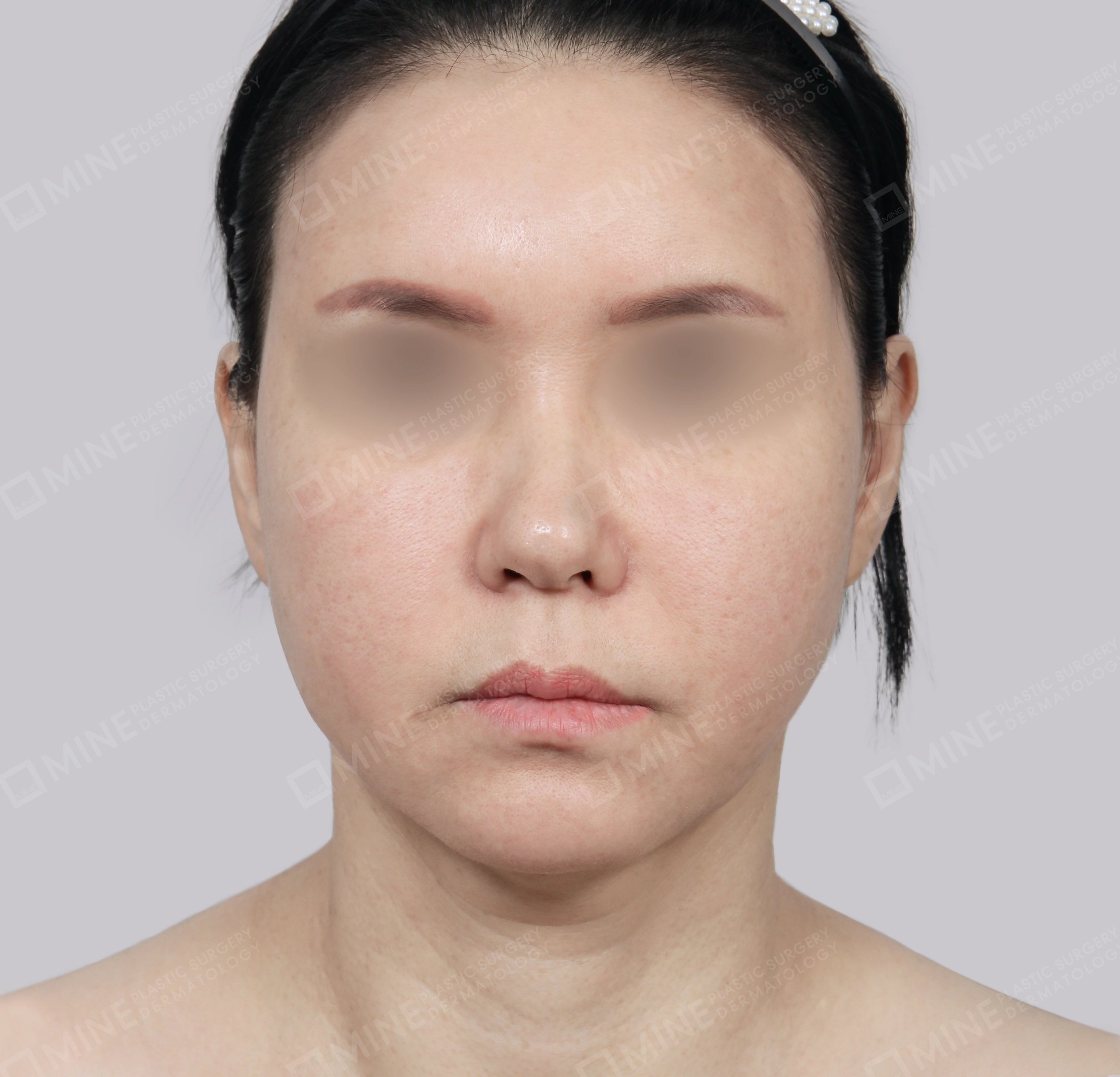 Căng da toàn mặt-Mặt trước-Trước