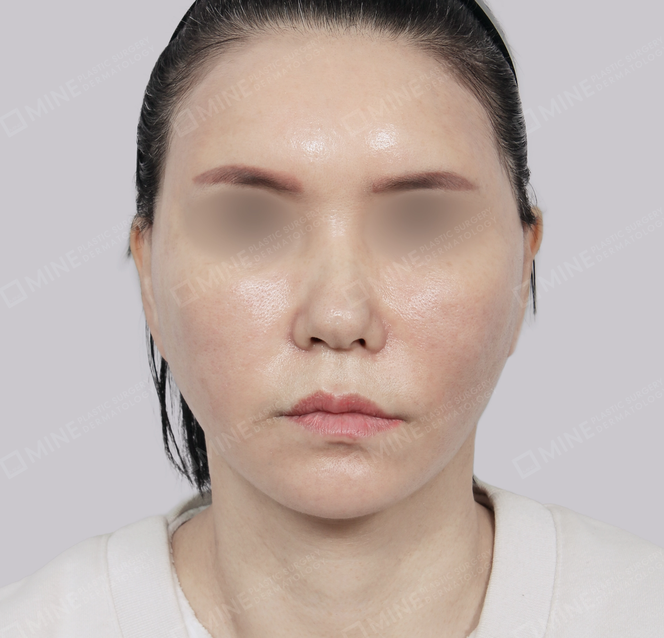 Căng da toàn mặt-Mặt trước-Sau